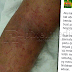 Hospital Cuai, Habis Tangan Abah Digigit Semut