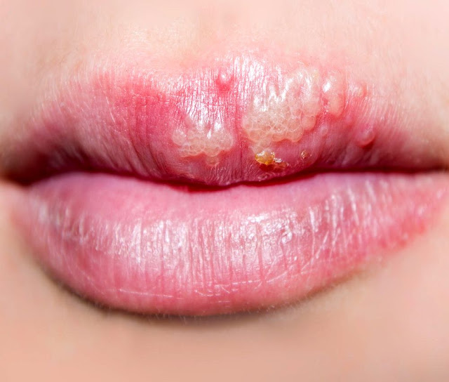 El beso de araña o herpes labial, es muy doloroso y molesto