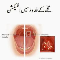 Tonsillitis Treatment In Urdu by Tib e Nabvi