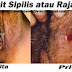 Obat Sifilis Ampuh