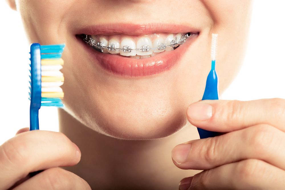 8 most frequent errors when brushing teeth with orthodontic treatment