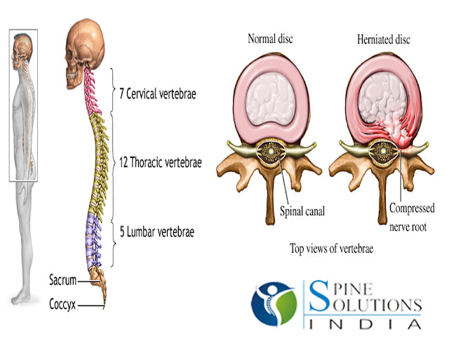 Spine Solutions India by Dr Sudeep Jain: Disc Herniation