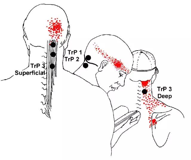 為什麼多數頭痛都緣於頸椎？(脖子僵硬、頸椎退變、脖子肌肉外傷)