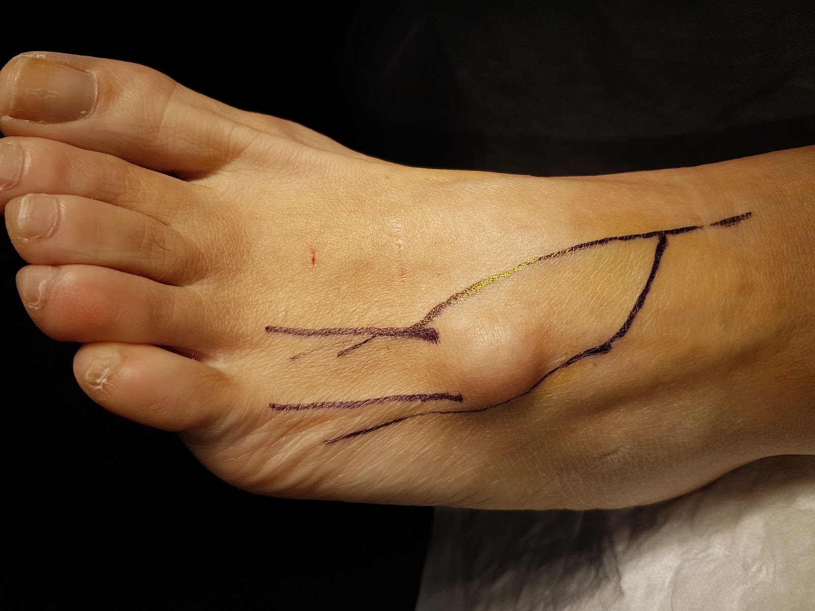 Ganglión. Quiste sinovial. Operación de ganglión