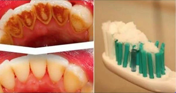 Say Goodbye To Caries, Tartar And The Yellow Color Of Your Teeth