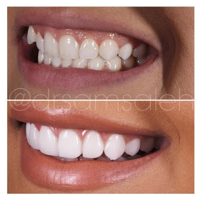 My Experience With Veneers 2 Year Update Parmida Kiani