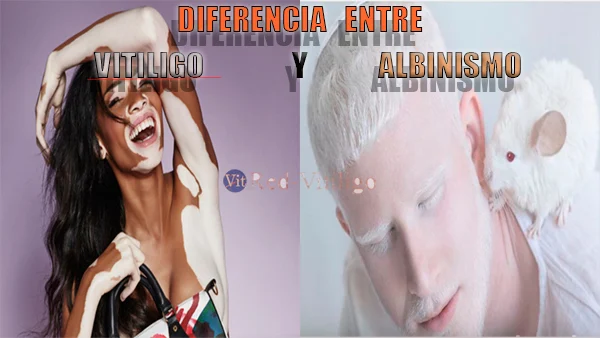 Diferencia-entre-vitiligo-y-albinismo