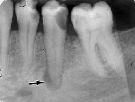 Well-defined+radiolucent+lesion.jpg