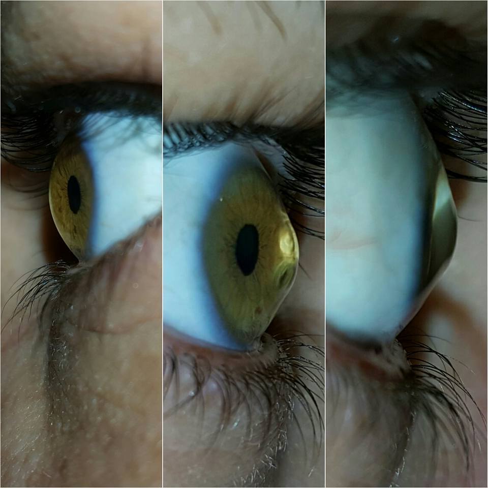 Keratoconus (Conical Cornea) Photo Taken with a Galaxy Note 5
