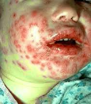 Penyakit Herpes Anak