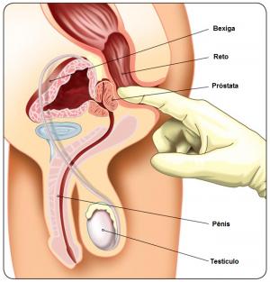 adenocarcinoma prostatico ed pcri