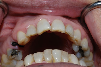 Có nên nhổ răng hàm dưới bị sâu không?