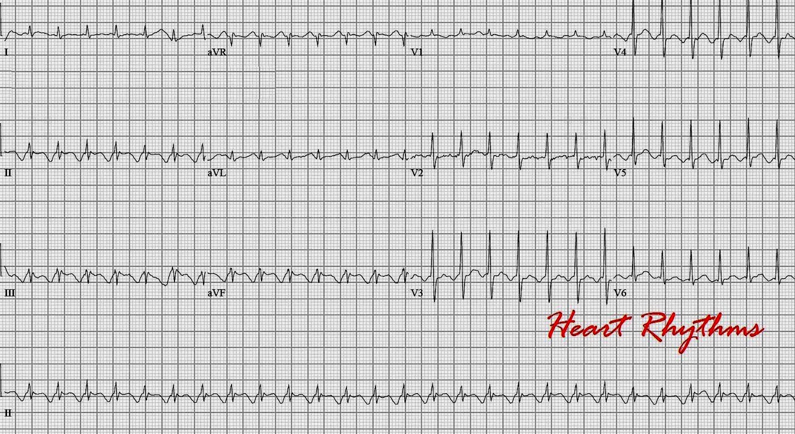ECG Rhythms Differential diagnosis of long RP tachycardia with