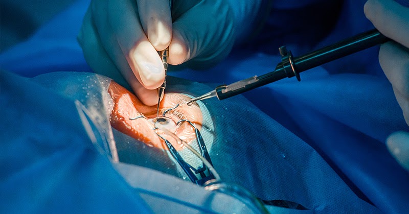 Cataract Surgery to Improve Vision Now Routine