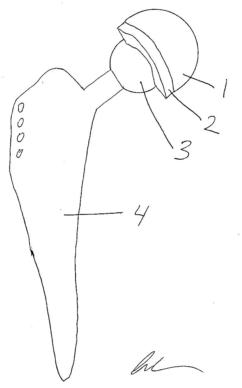 Interesting Topics in Orthopedic Surgery by Dr. Nasar What is a Hip