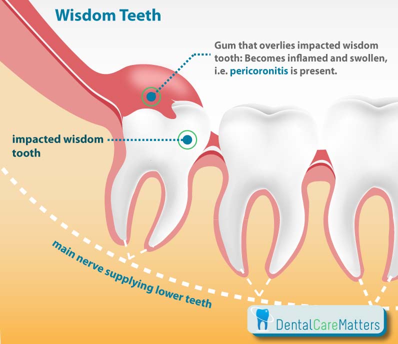 Can impacted wisdom teeth cause pain in other teeth