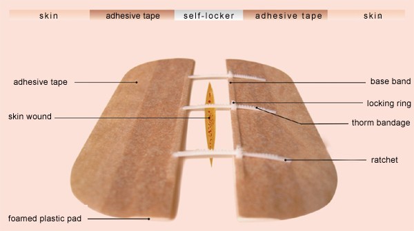 Lumtum's I: Wound Closure – 3 emerging technologies to watch