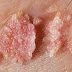 Obat Mematikan Virus Hepatitis B thumbnail