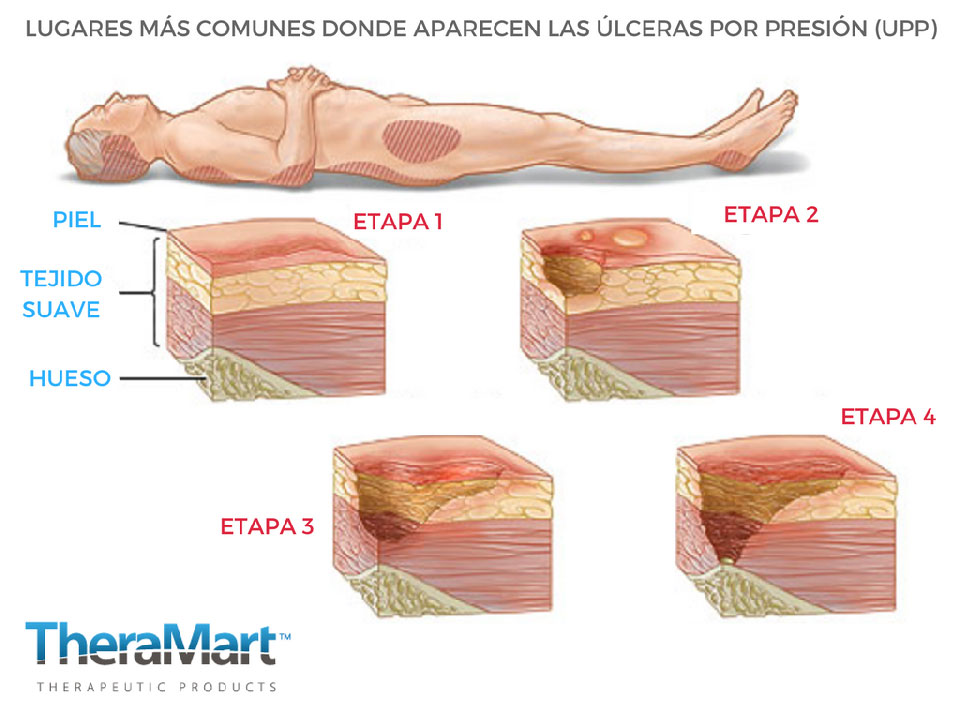 Todo sobre Enfermería ULCERAS POR PRESIÓN PLANES DE CUIDADO DE