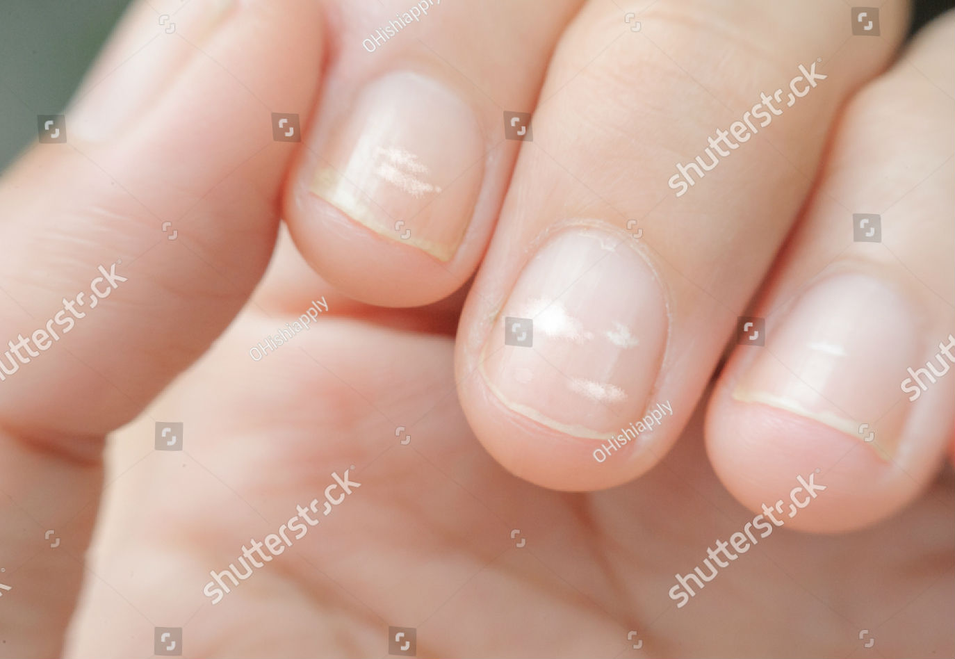 White Spots On Nails Zinc Deficiency