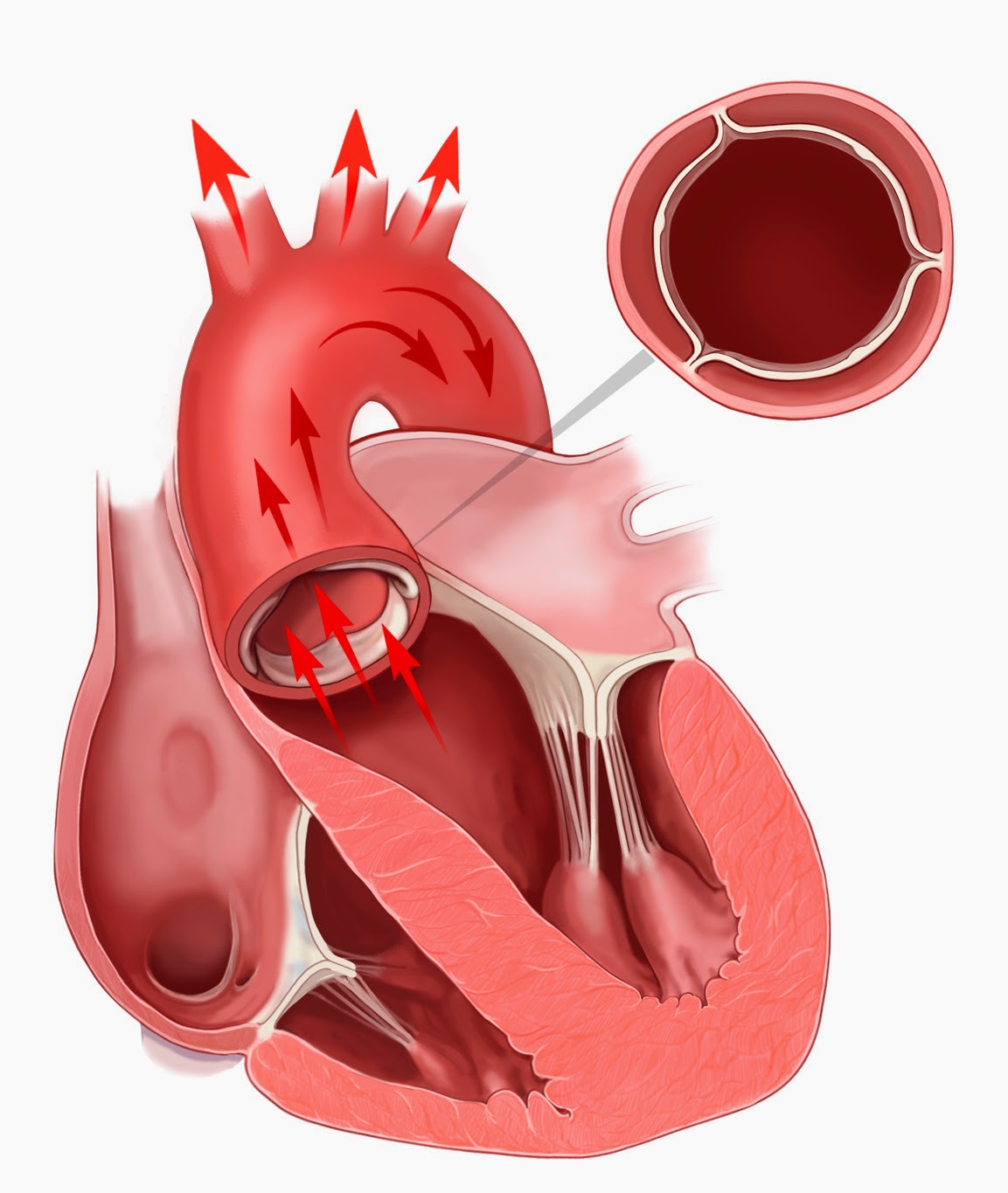 Сердечный стеноз. Метоальгыц аортальный клапаны. Стеноз митрального и аортального клапана. Порок сердца стеноз аортального клапана. Митральный и аортальный клапан.