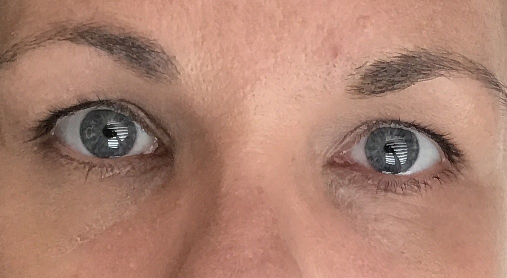 Xanthelasma Removal