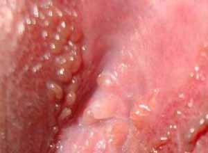 Cara Ampuh Untuk Menghilangkan daging tumbuh di dalam miss v Cara Ampuh Untuk Menghilangkan daging tumbuh di dalam miss v