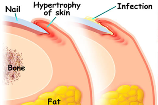 Ingrown nail illustration