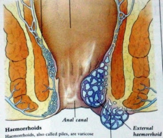 obat ambeien tradisional paling ampuh