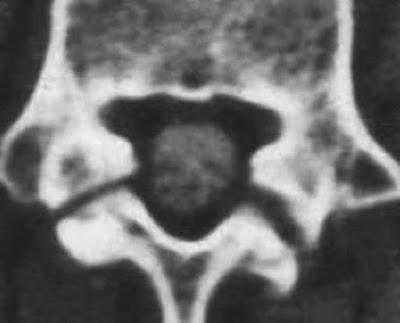 CT Scan of Bilateral Fractures CT Scan of Bilateral Fractures - El Paso Chiropractor