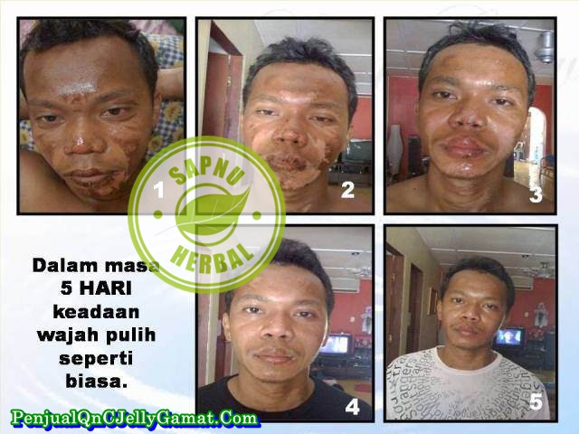 Obat Tradisional Untuk Luka Menganga Obat Tradisional Untuk Luka Menganga