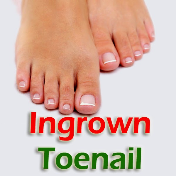 Healthgare: Ingrown Toenail: Home Doctor & Self Therapy