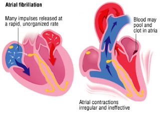 signs of heart arrhythmia signs of heart arrhythmia