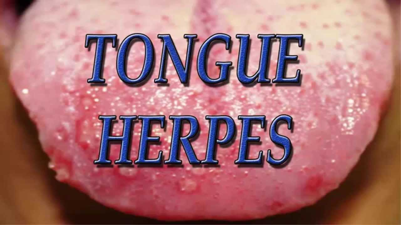Herpes On Tongue Causes Symptoms And Guaranteed Natural Treatment