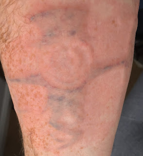 Laser Tattoo Removal Tattoo 48 hours after picosure laser removal