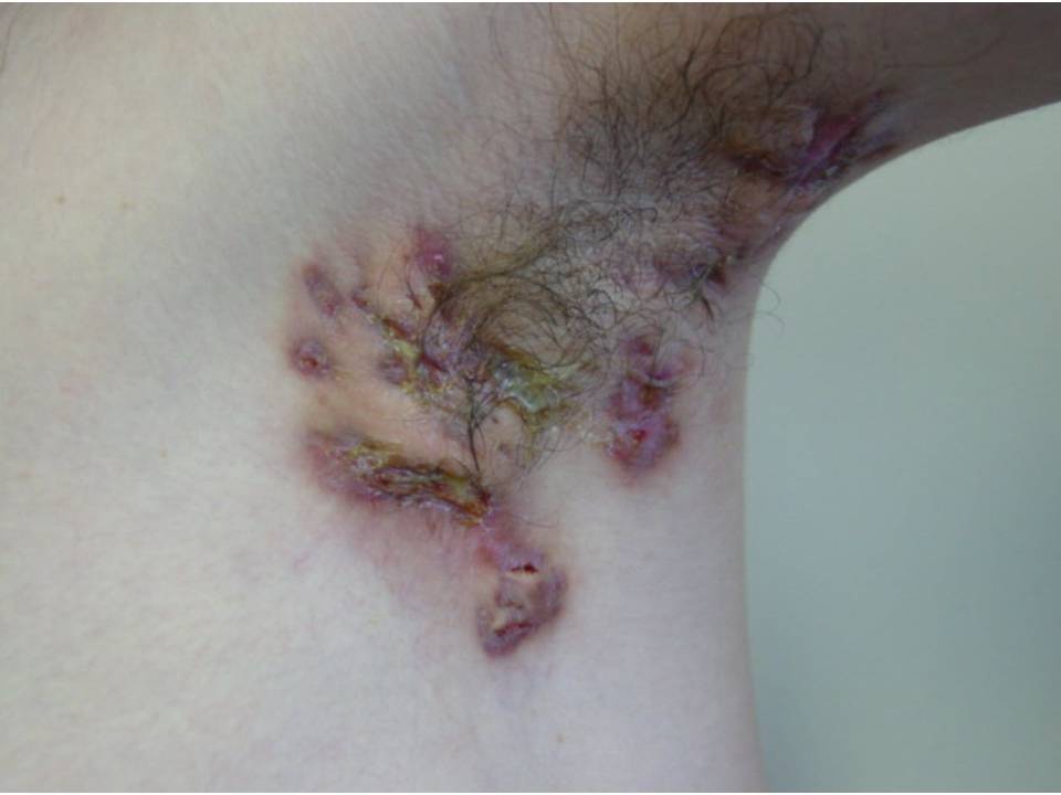 Consultations in Dermatology Hidradenitis Suppurativa