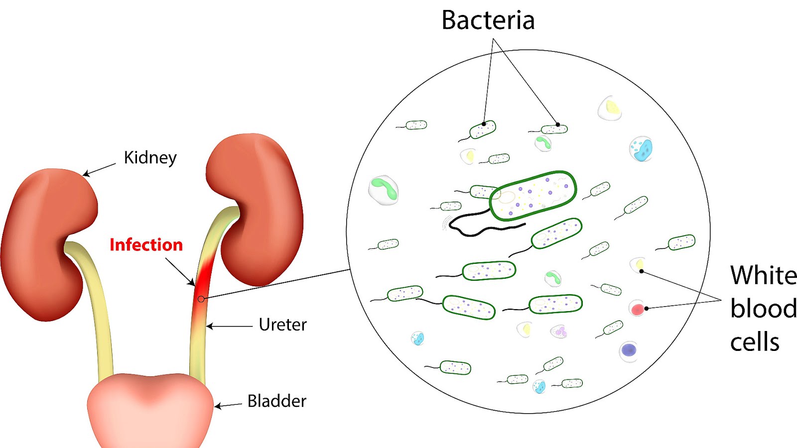 Urinary Tract Infection Side Effects Effect Choices