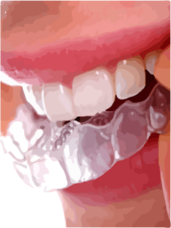 dental attrition