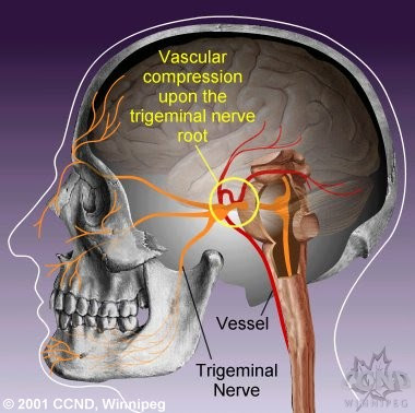 Notez On Nursing....: Cranial nerve V-The Trigeminal nerve, and some