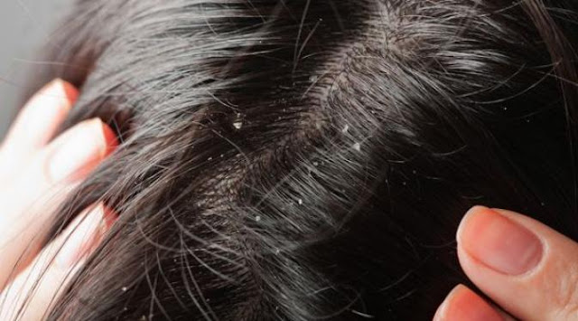 5 Bahan Alami Bisa Menghilangkan Gatal di Kulit Kepala, obat rambut