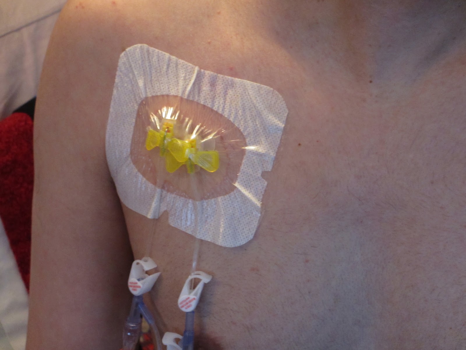 1 in 100 Million: My Fight with Ewing's Sarcoma: Almost Halfway Through