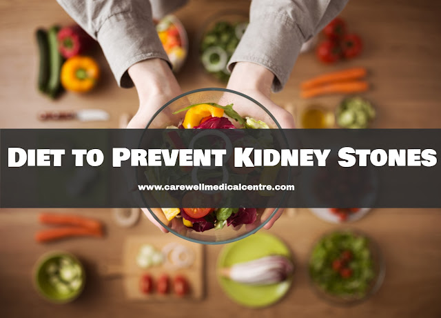 Diet to Prevent Kidney Stones