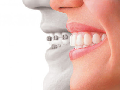 Phương pháp điều trị răng hô như thế nào?