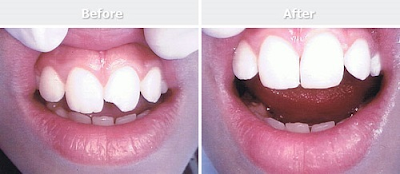 Trám răng cửa bị mẻ giúp phục hình như răng thật