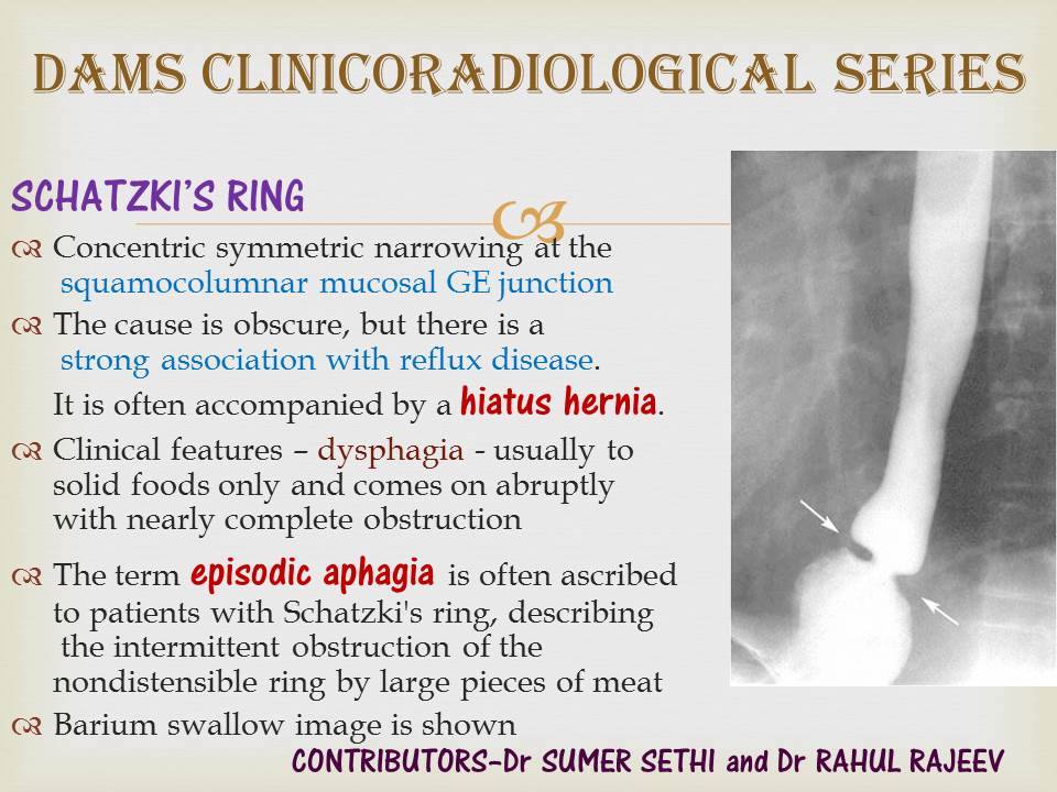 Schatzki's RingClinicoradiological Series Sumer's Radiology Blog