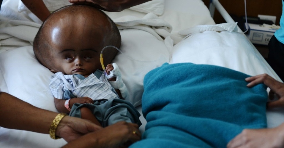 . Vera quer tratamento prioritário para crianças com hidrocefalia na rede pública