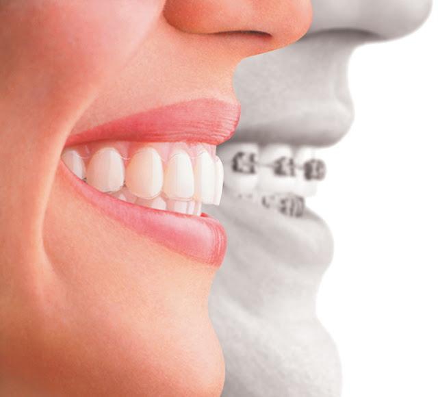 invisalign melbourne invisalign melbourne