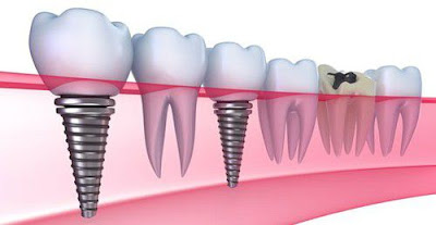 Cấy ghép Implant không đau