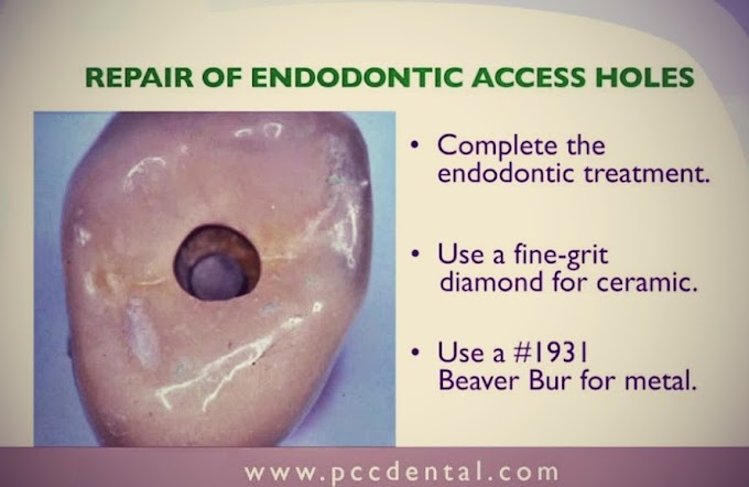 ENDODONTIC Access Hole - Dr. Gordon Christensen