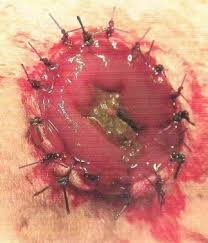 komplikasi atresia ani